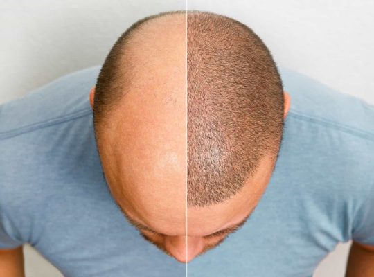 causes of failure in fue hair transplant