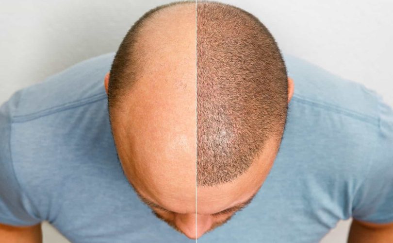 causes of failure in fue hair transplant