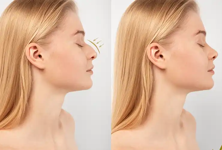 Rhinoplastik
