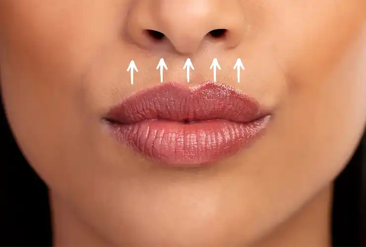 Lip Lift