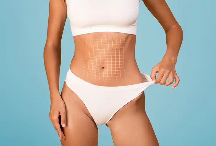 Tummy Tuck